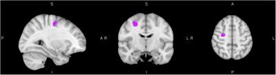 Neural Correlates of Reactive Aggression in Adult Attention-Deficit/Hyperactivity Disorder